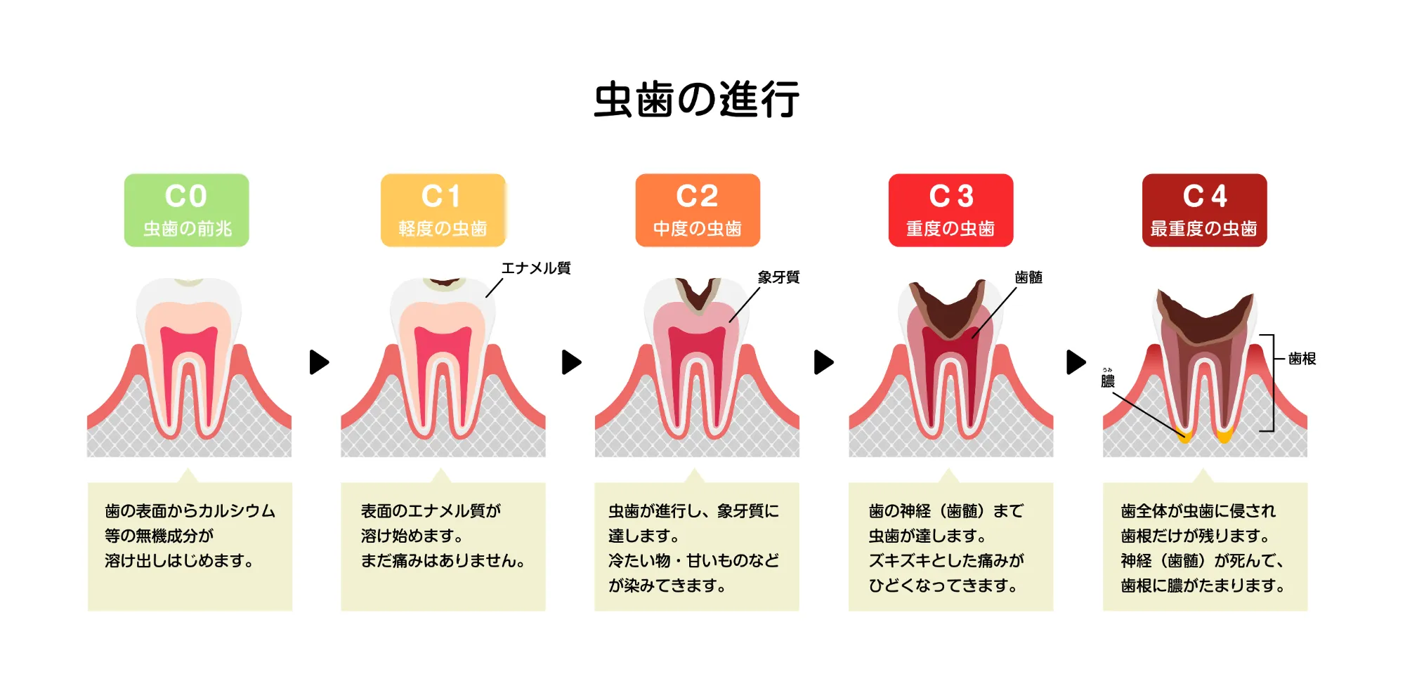 虫歯の進行度に応じた治療