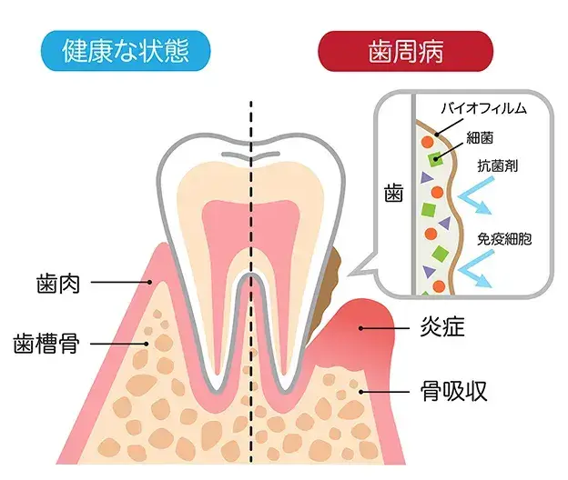 歯周病の症状