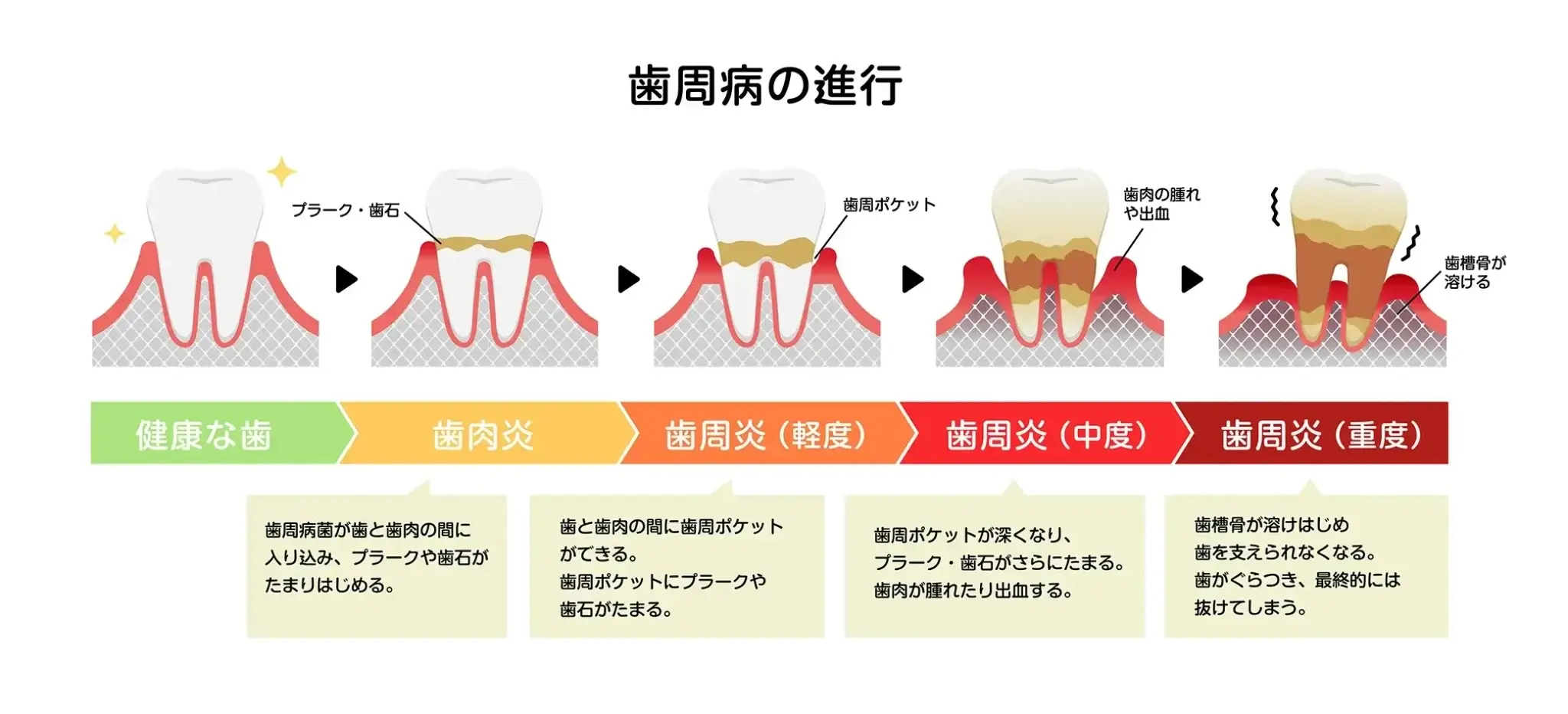 歯周病の進行
