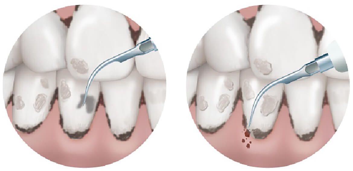 歯槽膿漏に対するスケーリングの有効性