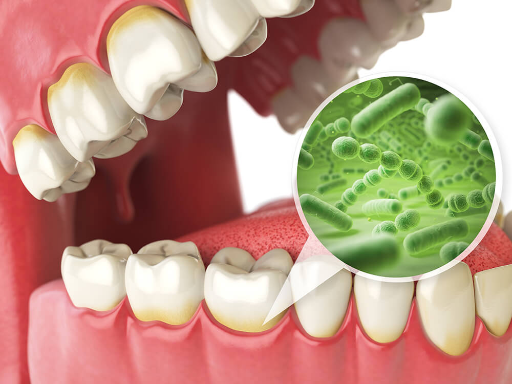 歯周病についての理解と対策